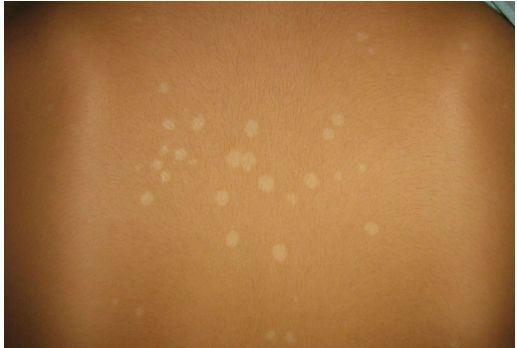 花斑癣危害不容小觑_金华婺城皮肤病防治院【官网】